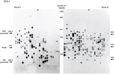 Repeat Interruptions Modify Age at Onset in Myotonic Dystrophy Type 1 by Stabilizing DMPK Expansions in Somatic Cells